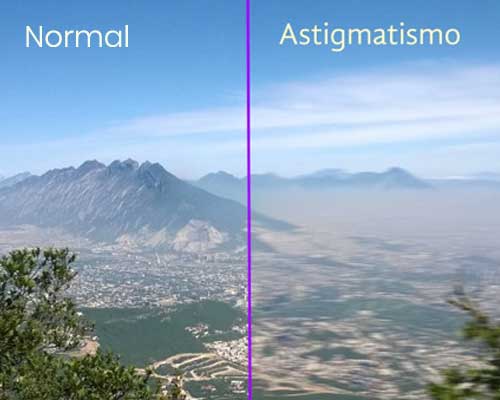 Astigmatismo